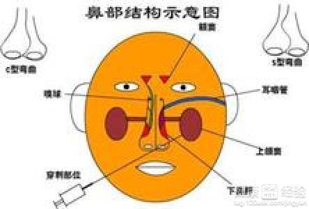 鼻竇炎有哪些癥狀用什么藥治療,鼻竇炎的癥狀、治療與用藥全面分析說明,系統解答解釋定義_版章90.87.11