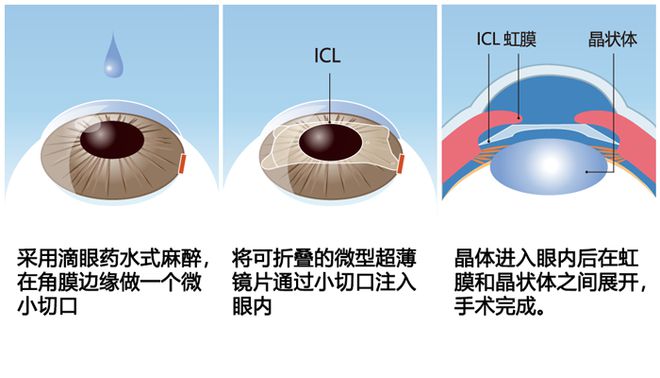 晶體植入近視手術(shù),晶體植入近視手術(shù)與結(jié)構(gòu)化推進(jìn)評估，未來的眼科醫(yī)療革新,專業(yè)研究解釋定義_升級版17.51.59