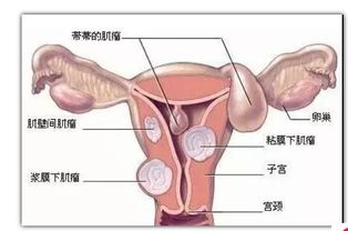 子宮內膜增厚是什么意思,子宮內膜增厚，定義、原因與應對的精準解答,全面應用分析數據_凸版印刷48.58.36