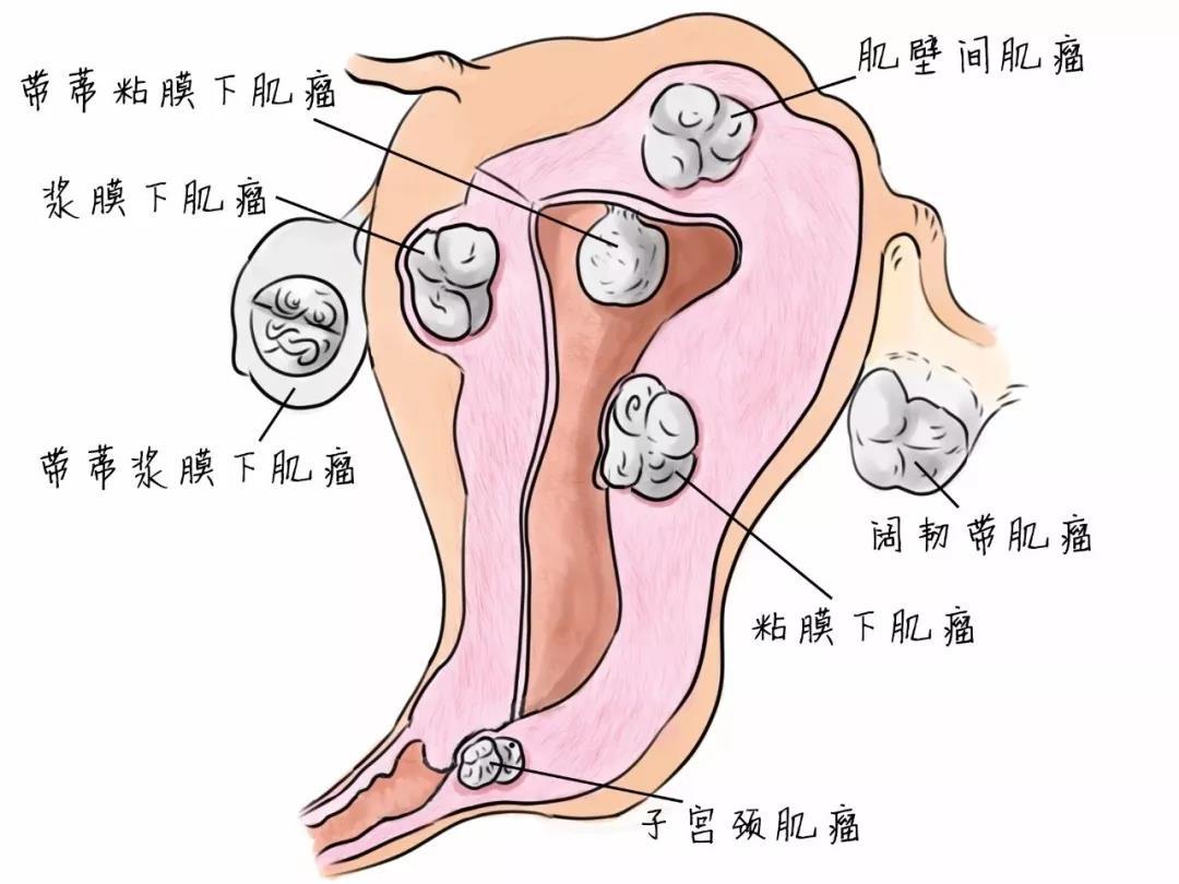 子宮肌瘤咨詢免費專家,子宮肌瘤咨詢免費專家，深度解析與數(shù)據(jù)執(zhí)行研究,創(chuàng)新策略解析_云端版21.84.98