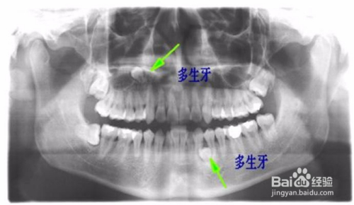 多生牙拔除大概需要多少費用,關于多生牙拔除費用及實地考察數據應用的探討——以宋版95.49.41為參考,預測解讀說明_Premium19.54.64