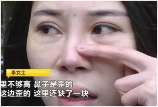 女子花數萬修復鼻孔卻被弄歪鼻梁