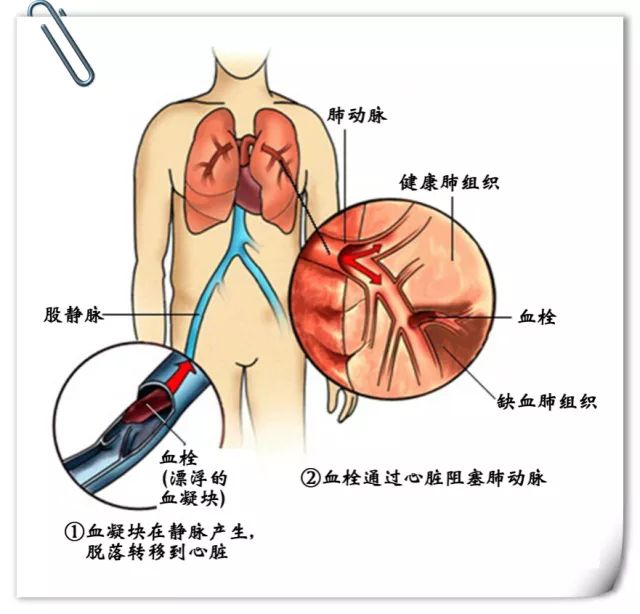 4949澳門正版資料,女子崴腳靜養一周后竟引起肺栓塞